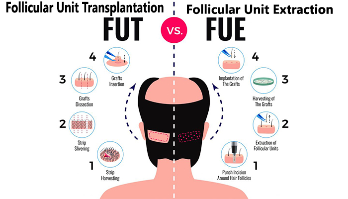 FUT vs FUE